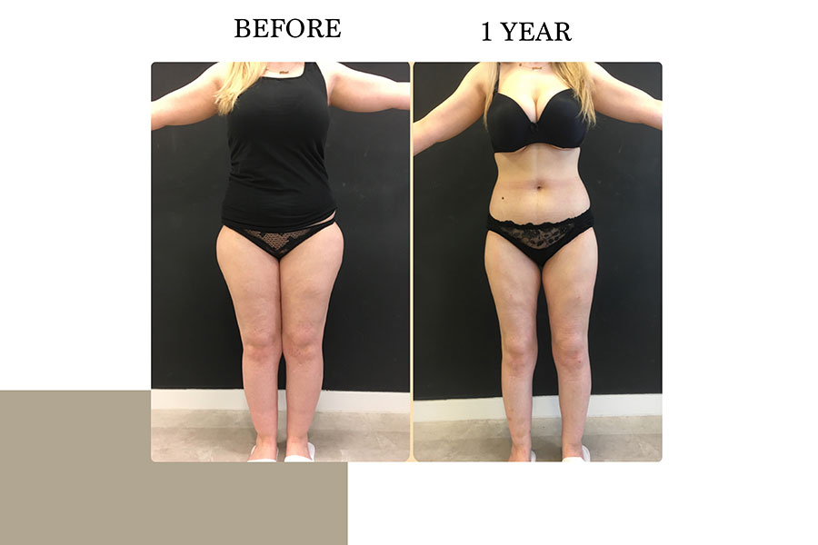 Before & After | Lymph Protective VASER Liposuction is the main building block of Lipoedema Treatment