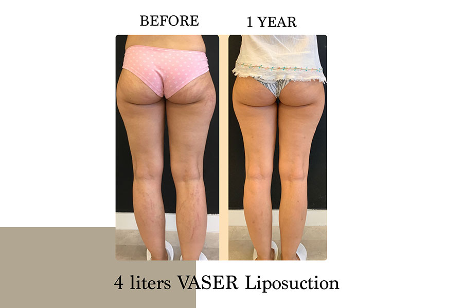 Before & After | Lymph Protective VASER Liposuction is the main building block of Lipoedema Treatment