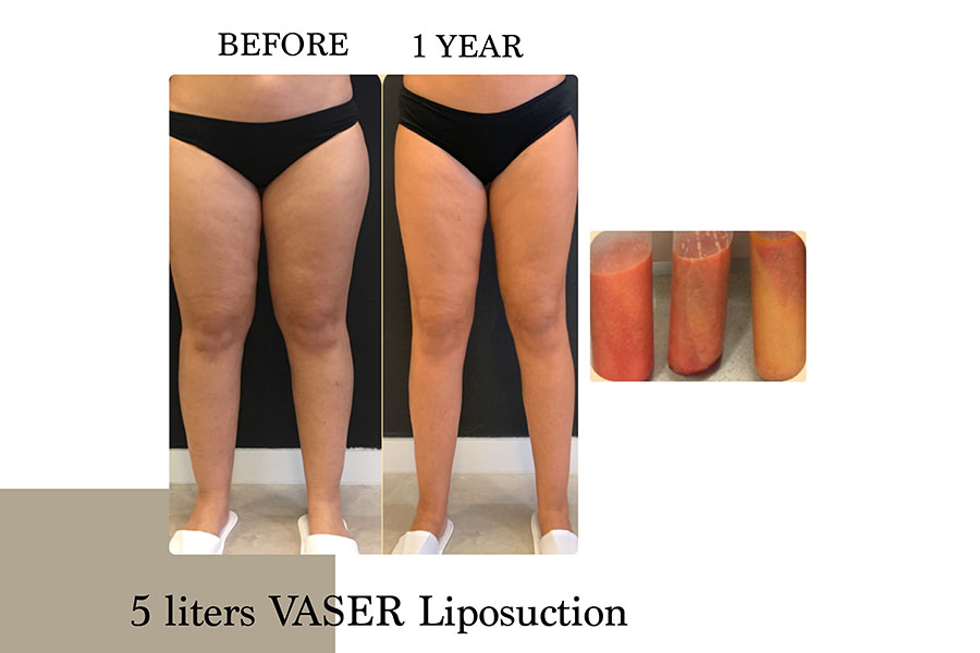 Before & After | Lymph Protective VASER Liposuction is the main building block of Lipoedema Treatment