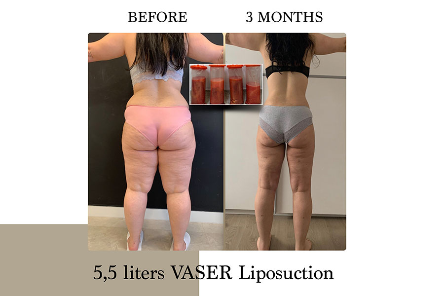 Before & After | Lymph Protective VASER Liposuction is the main building block of Lipoedema Treatment