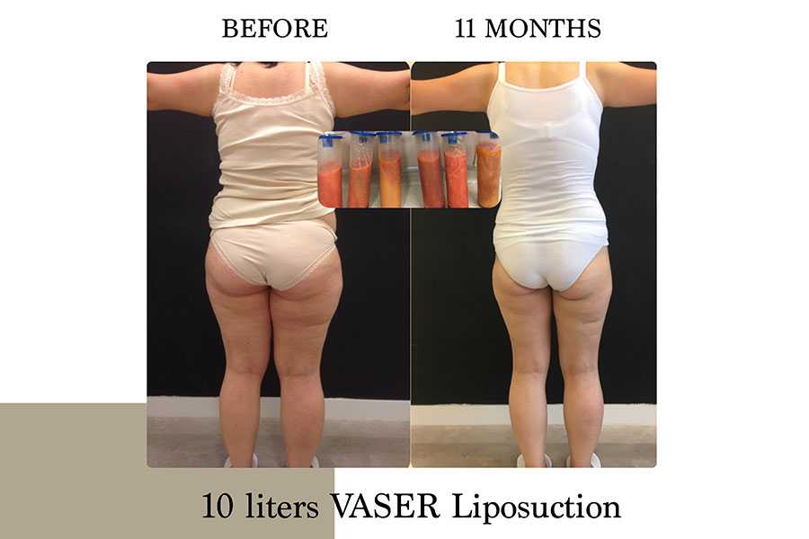 Before & After | Lymph Protective VASER Liposuction is the main building block of Lipoedema Treatment