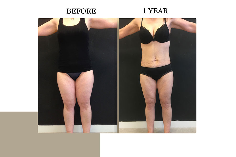 Before & After | Lymph Protective VASER Liposuction is the main building block of Lipoedema Treatment