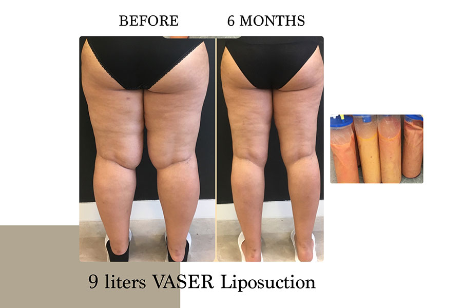 Before & After | Lymph Protective VASER Liposuction is the main building block of Lipoedema Treatment