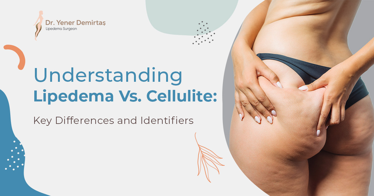 Understanding Lipedema Vs. Cellulite: Key Differences and Identifiers