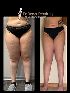 Lipedema Surgery, Before and After