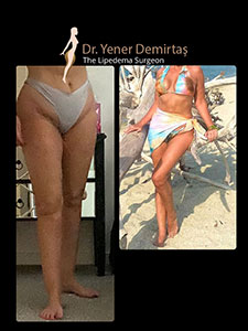 Lipedema Surgery, Before and After