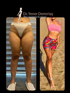 Lipedema Surgery, Before and After