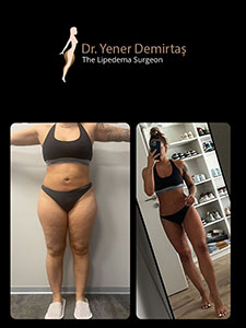 Lipedema Surgery, Before and After