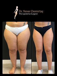 Lipedema Surgery, Before and After