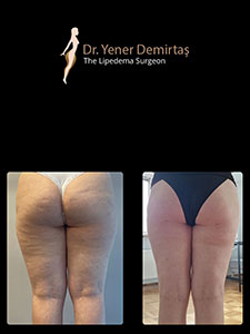 Lipedema Surgery, Before and After