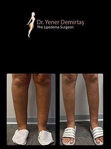 Lipedema Surgery, Before and After