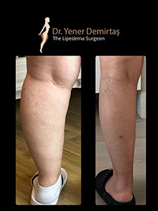 Lipedema Surgery, Before and After