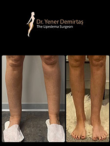 Lipedema Surgery, Before and After