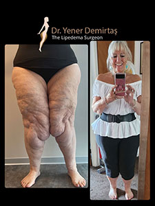 Lipedema Surgery, Before and After