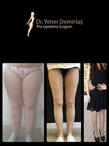 Lipedema Surgery, Before and After