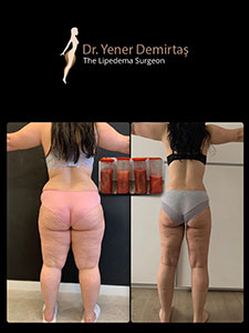 Lipedema Surgery, Before and After