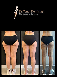 Lipedema Surgery, Before and After