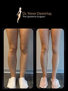 Lipedema Surgery, Before and After