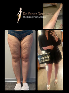 Lipedema Surgery, Before and After