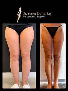 Lipedema Surgery, Before and After