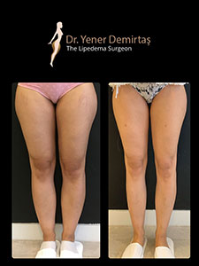 Lipedema Surgery, Before and After