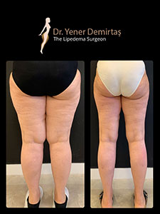 Lipedema Surgery, Before and After