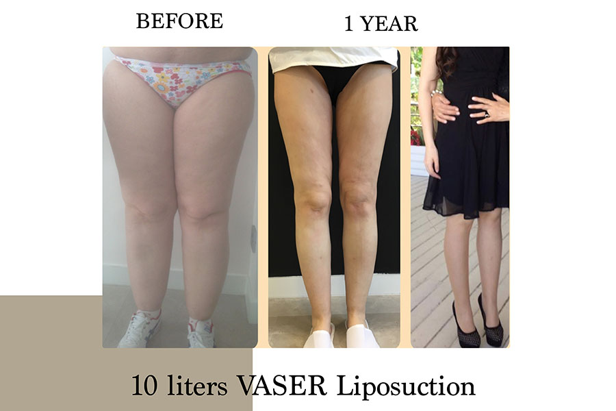 Before & After | Lymph Protective VASER Liposuction is the main building block of Lipoedema Treatment