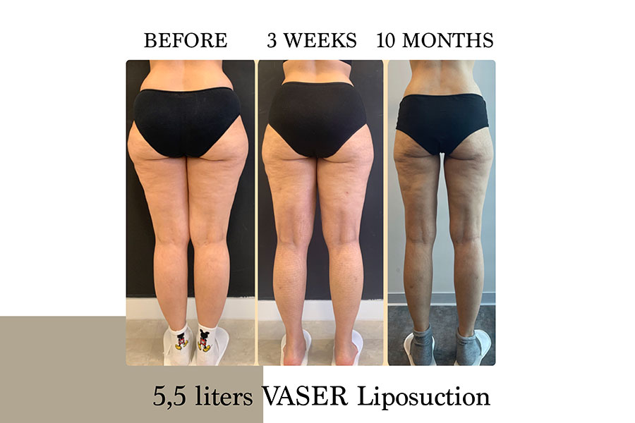 Before & After | Lymph Protective VASER Liposuction is the main building block of Lipoedema Treatment