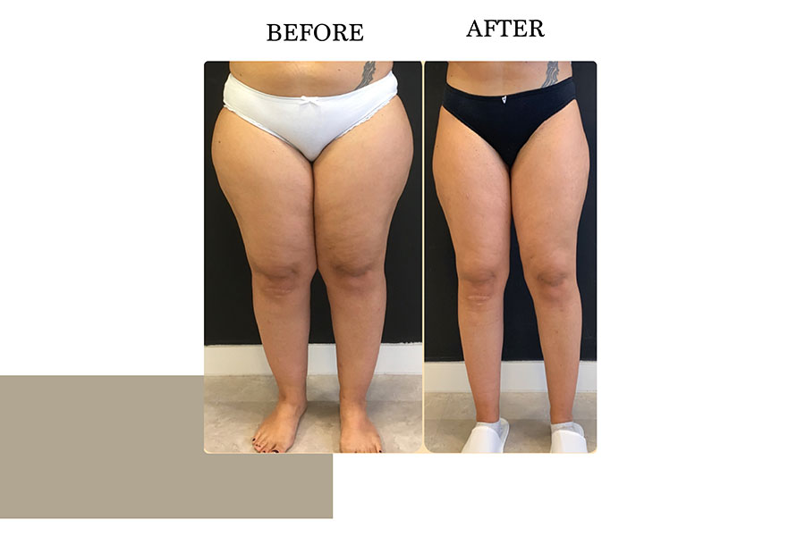 Before & After | Lymph Protective VASER Liposuction is the main building block of Lipoedema Treatment