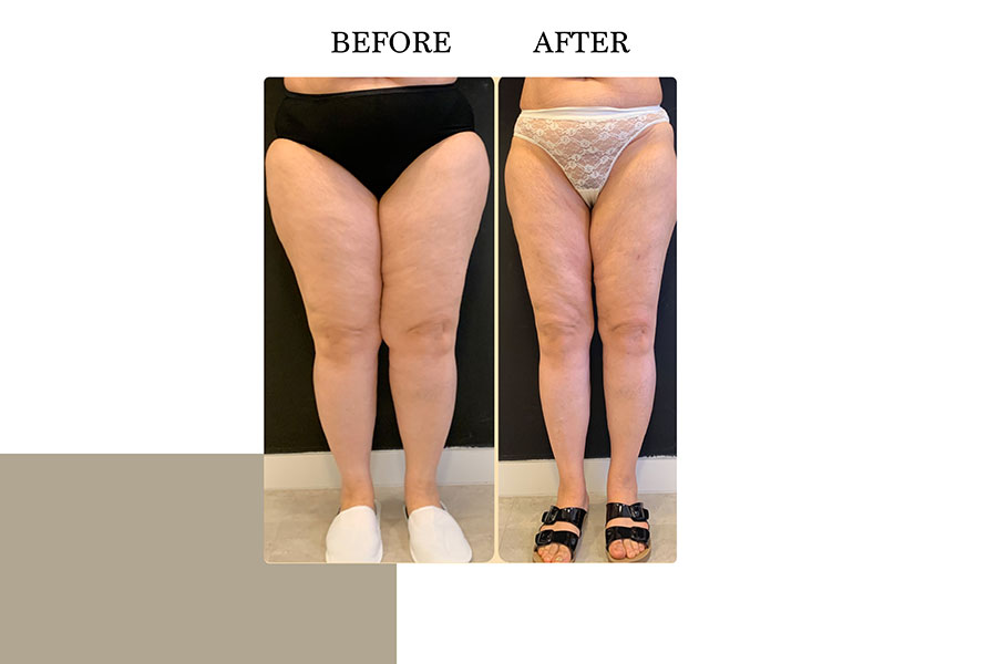 Before & After | Lymph Protective VASER Liposuction is the main building block of Lipoedema Treatment