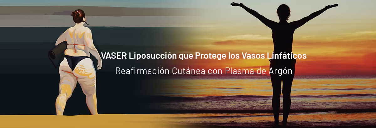 VASER Liposucción que Protege los Vasos Linfáticos, Reafirmación Cutánea con Plasma de Argón
