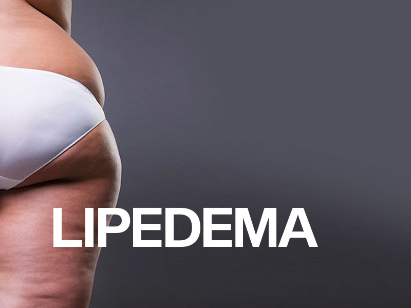 ¿Qué es el lipedema? Todo lo que quieres saber sobre el lipedema